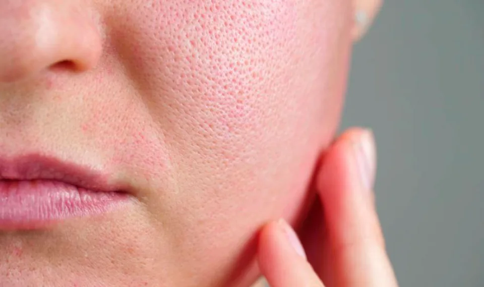 طرق العناية بمسامات الوجه وكيفية تقليل ظهورها - صورة 2