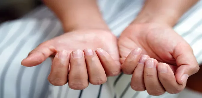 ما هي أعراض نقص الحديد ؟ - صورة 2