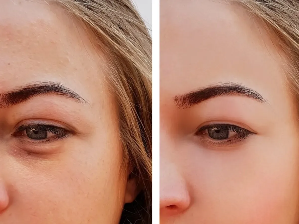 "مشكلة الانتفاخ في العيون: كشف الأسباب والحلول المحتملة" - صورة 2