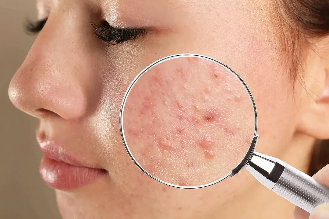 5 حلول سريعة للتخلص من البثور المزعجة