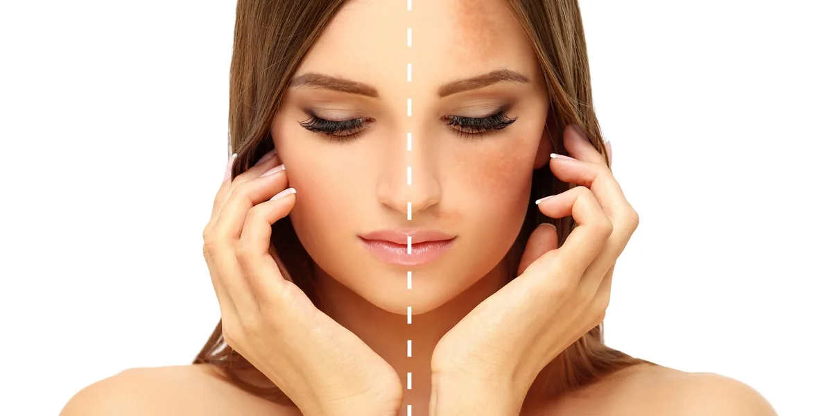 طرق تساعدك على التخلص من تصبغات الوجه
