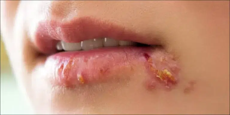 ما هي أسباب مرض الهربس التناسلي؟
