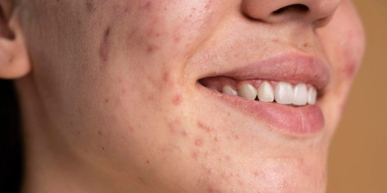 10 أطعمة مذهلة لمكافحة حب الشباب