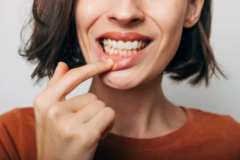 5 وسائل منزلية فعّالة للتخلص من قرح الفم بسرعة